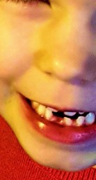 Mund eines Kindes, vorne unten klafft eine Zahnlücke